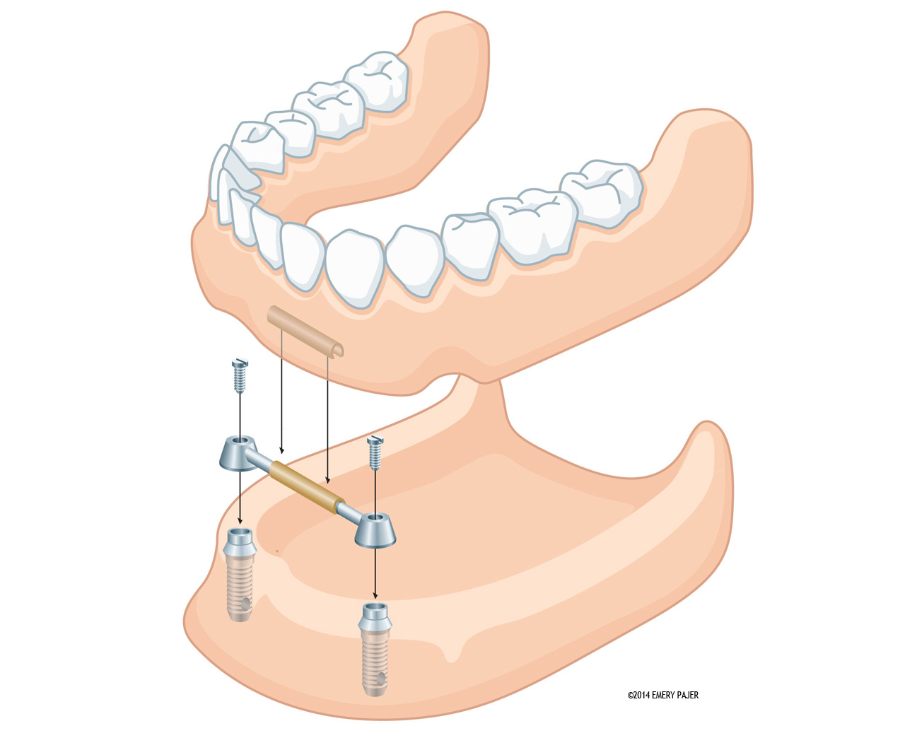 product illustration, dental prosthetic